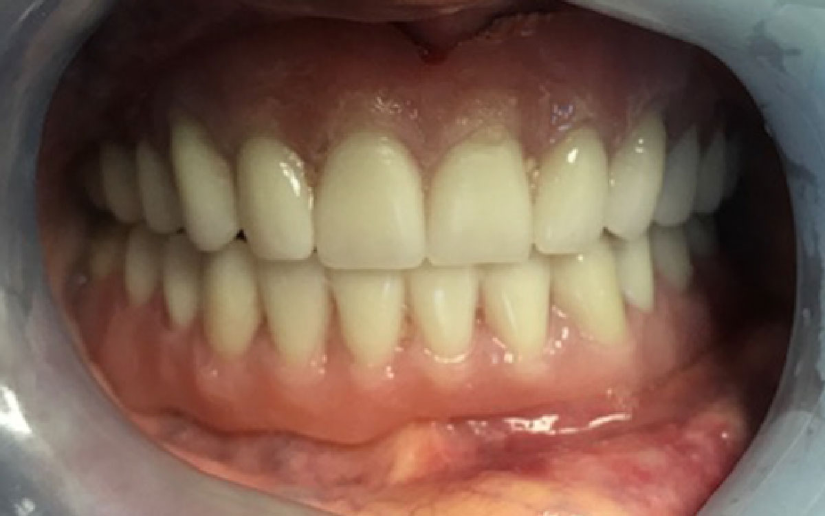 After: Dentures